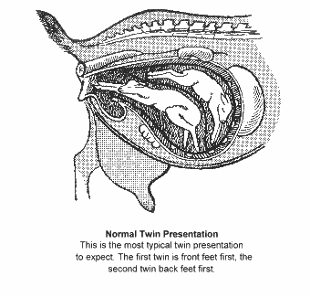 Normal Twin Presentation